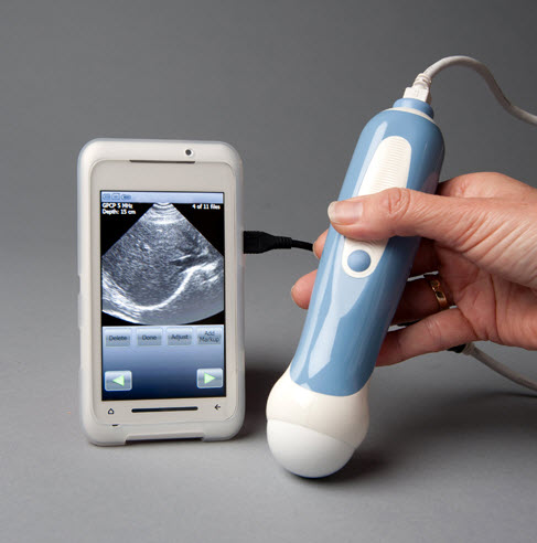 Mobisante’s Ultrasound Device works with a smartphone