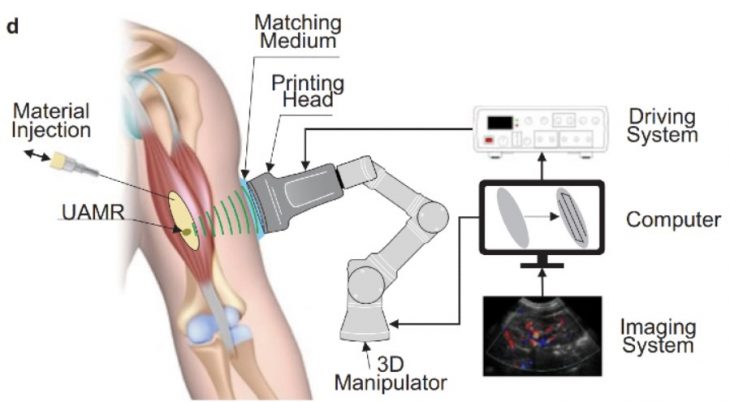 Direct Sound Printing – researchers hope to 3D print implants into our body without surgery